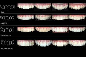 clear prevalence of tooth forms and their gender correlation