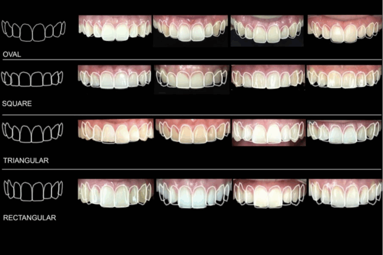clear prevalence of tooth forms and their gender correlation