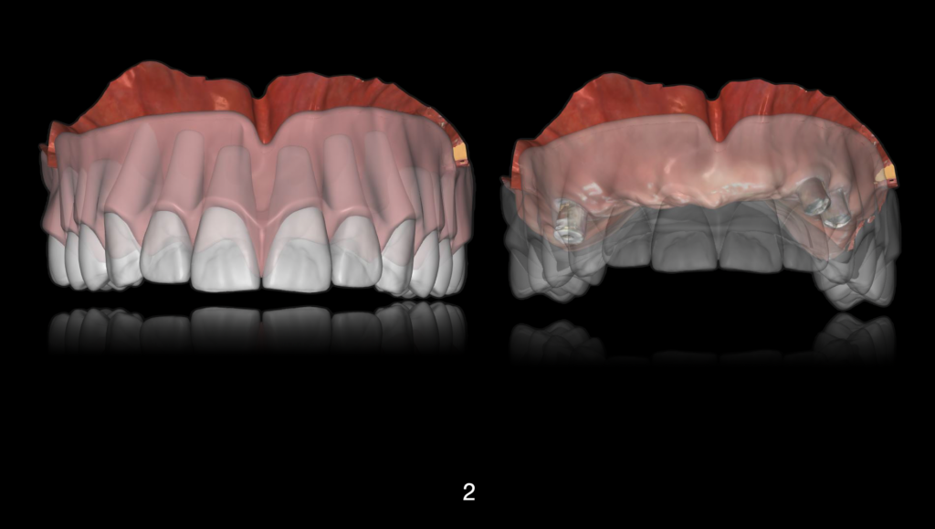 Under optimal circumstances, the primary impression may be used for the fabrication of a trial prosthesis (try-in). Based on this, primary esthetic and functional parameters can be evaluated.