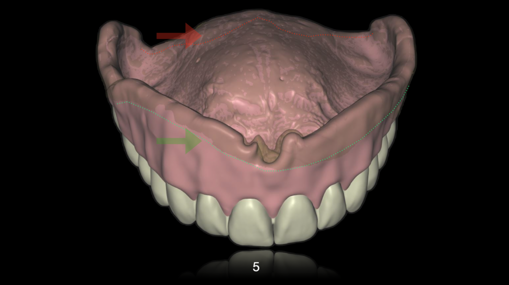 In this image, the critical areas captured in the analog impression and subsequently digitized through a mixed digital workflow protocol are delineated.