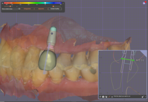 Prosthetically Driven Implant Placement: Concept and Scientific Evidence