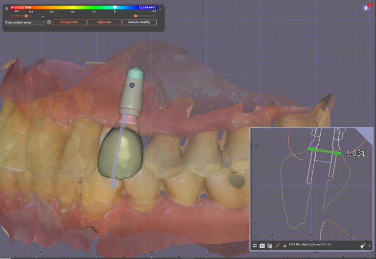 Prosthetically Driven Implant Placement: Concept and Scientific Evidence