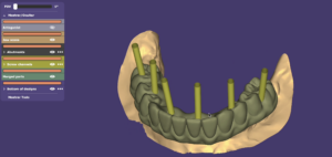 3D digital design of a full-arch implant restoration using advanced dental cad cam software showing screw channels and jaw scans for a smile design dental laboratory workflow.