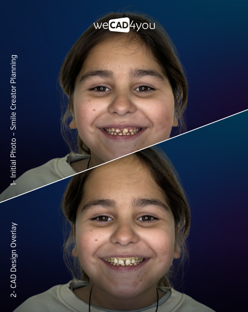 Initial smiling photo of a 11-year-old patient compared with a Smile Creator digital CAD design overlay