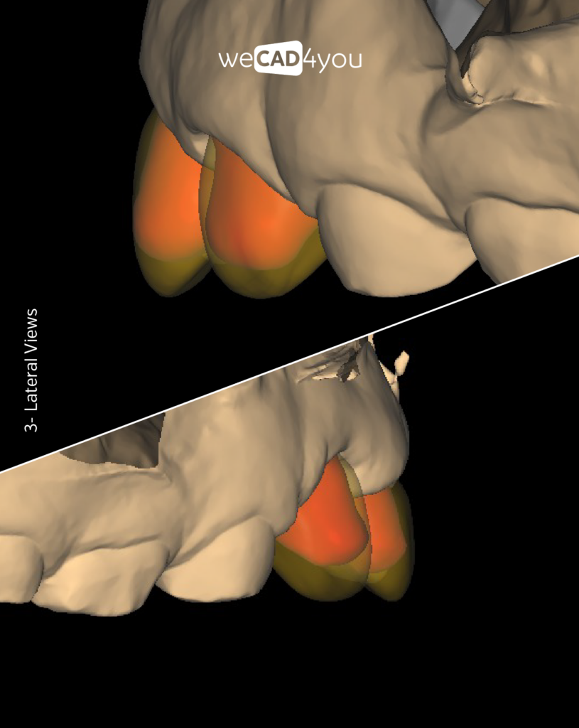 Lateral CAD software views showing minimum manufacturing thickness color mapping on vital tooth preparations.