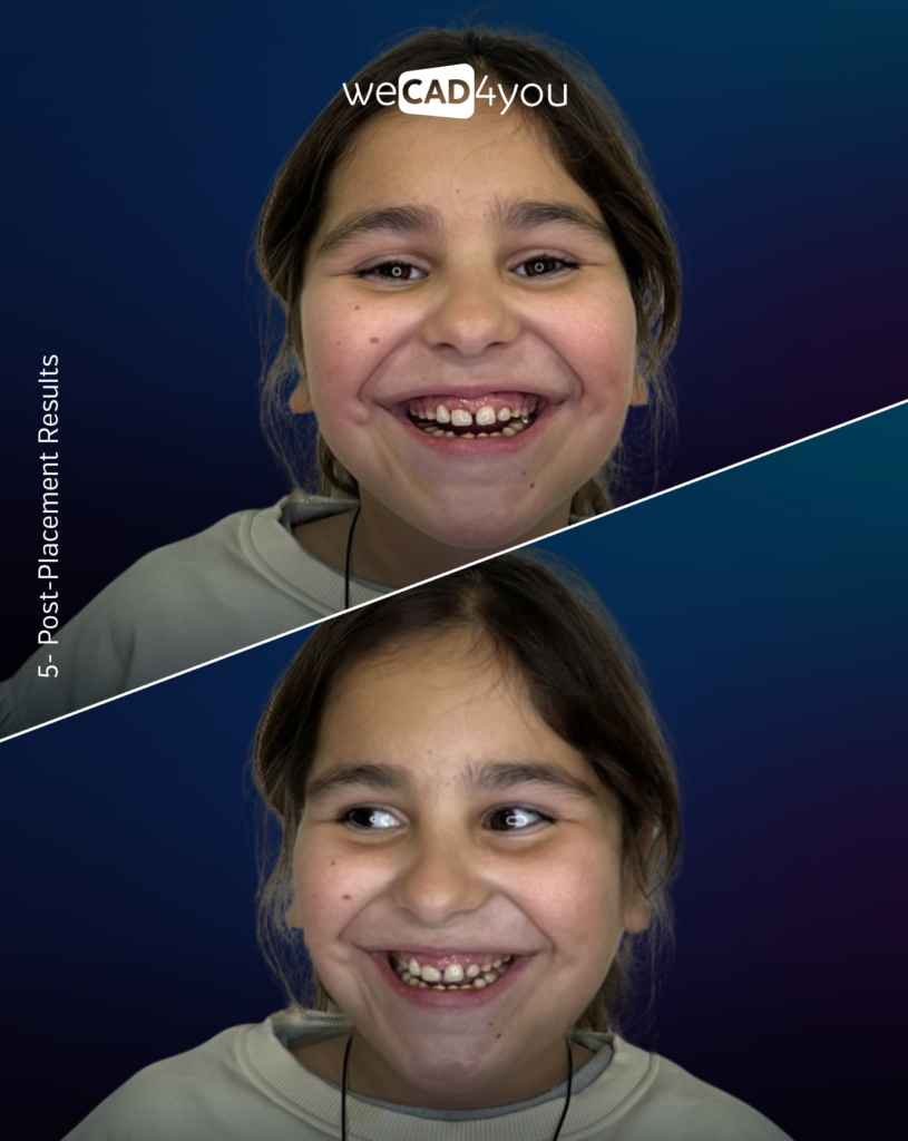 Post-placement clinical result photos showing a restored, natural smile on a 11-year-old patient.