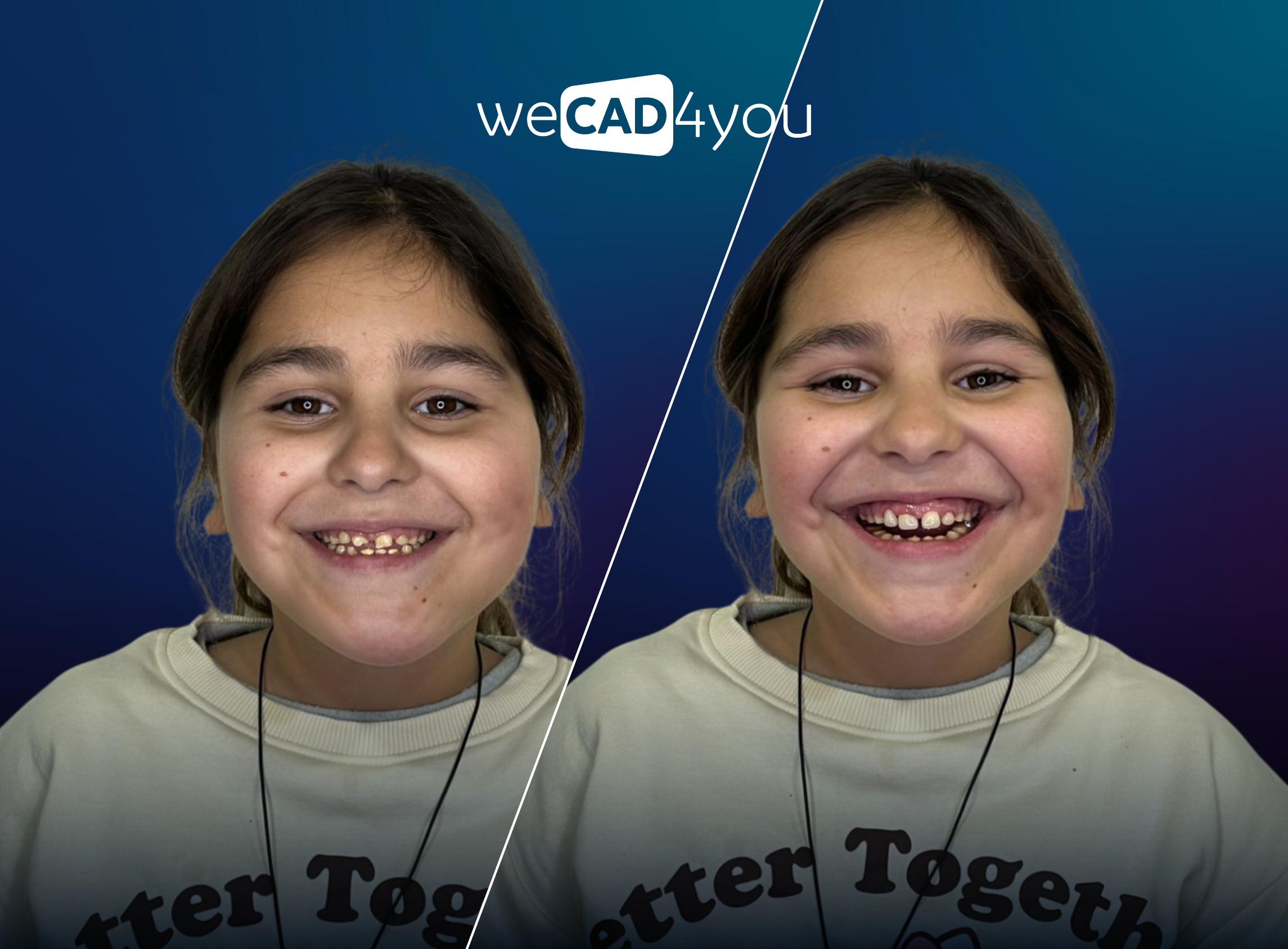 efore and after comparison of a pediatric CAD/CAM dental restoration for a 11-year-old patient with hypoplastic amelogenesis imperfecta.